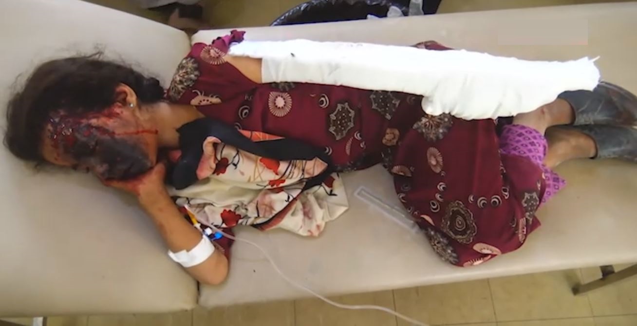 إصابة طفلة بانفجار قنبلة عنقودية في محافظة صعدة