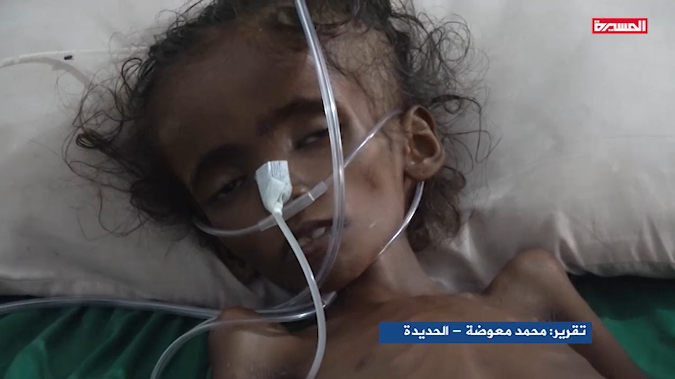 المعاناة الإنسانية وسوء التغذية في محافظة الحديدة 28-09-2019
